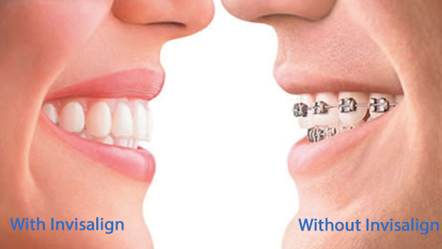 Invisalign in South Middlesex