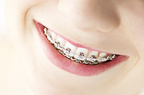 Braces in South Middlesex