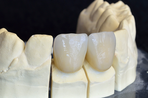 Ceramic Crowns South Middlesex