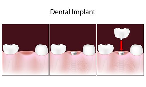 Dental Implants in Middlesex