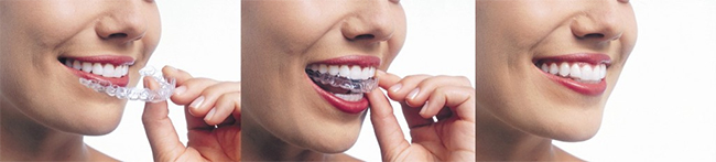 Middlesex Invisalign