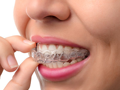Amaltas Dental Implant Center | Pediatric Dentistry, Oral Exams and Invisalign reg